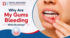 Why Are My Gums Bleeding While Brushing?