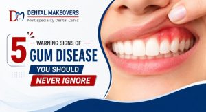 5 Warning Signs of Gum Disease You Should Never Ignore