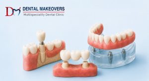 Dental Crowns & Bridges for Fixed Tooth Restoration