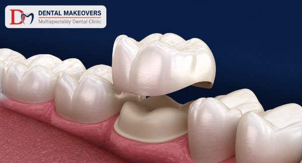 best dental clinic in Saket Indore
