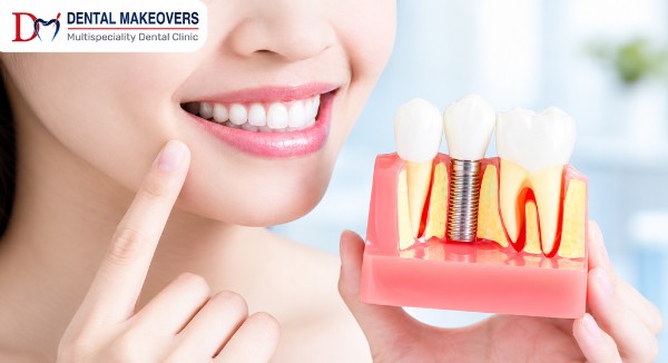 Dental Implant Indore Dental makeover