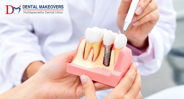Dental Implant Indore Dental makeover