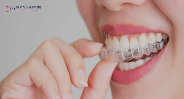 Best Invisible Braces Indore