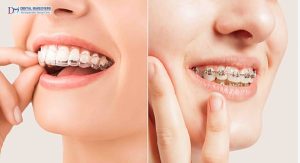 Best Invisible Braces Indore: Invisible Braces vs Metal Braces – Which Is Right for You?
