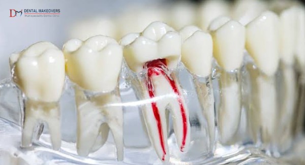 Best Root Canal Treatment in IndoreProcedure, Benefits & Recovery