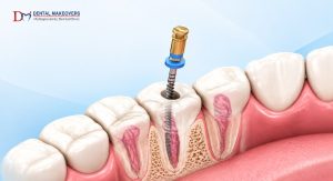 Why Are Young Adults Needing Root Canal Treatment Earlier Today?