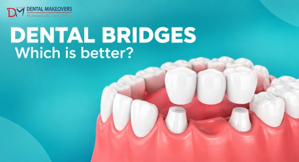 Dental Implant Indore Dental Makeover