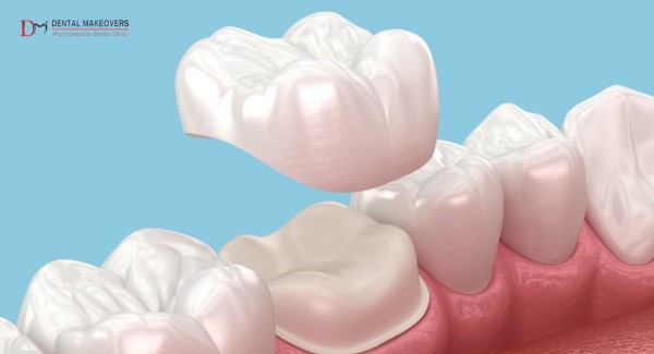 Best Root Canal Treatment in IndoreProcedure, Benefits & Recovery
