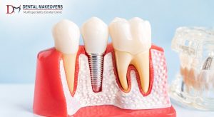 Dental Implant Indore: How to Care for Your New Dental Implants