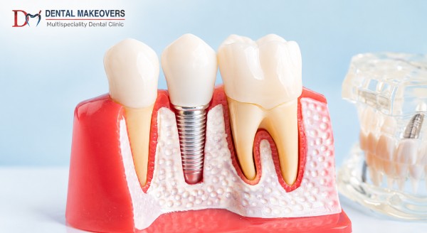 Dental Implant Indore Dental makeover
