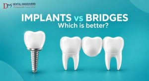 Dental Implant Indore: Dental Implants vs Bridges – Which Is Better?