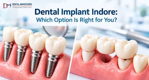 Dental Implant Indore Dental Makeover