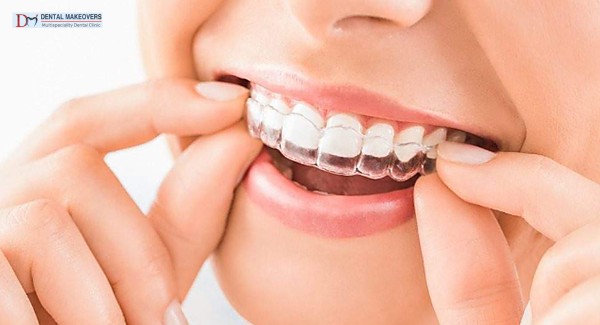 Best Invisible Braces Indore Invisible Braces vs Metal Braces