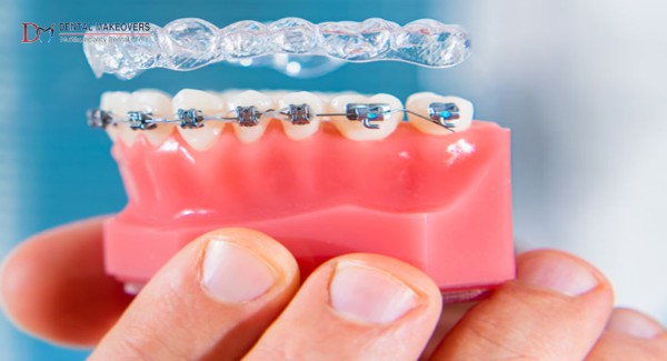 Best Invisible Braces Indore
