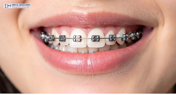 Best Invisible Braces Indore Invisible Braces vs Metal Braces