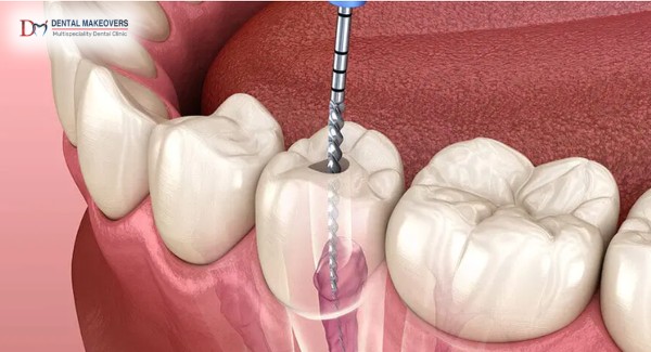 Best Root Canal Treatment in IndoreProcedure, Benefits & Recovery