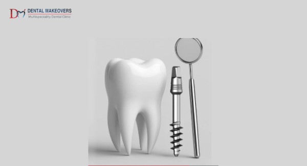 Dental Implant Indore: Best Solution for Missing Teeth